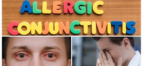 Göz Alerjisi Allerjik Konjonktivit